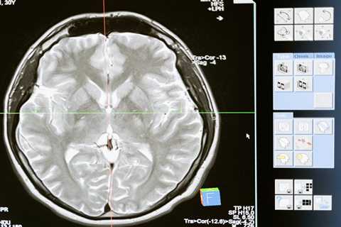 Healthy choices may reduce Alzheimer’s risk