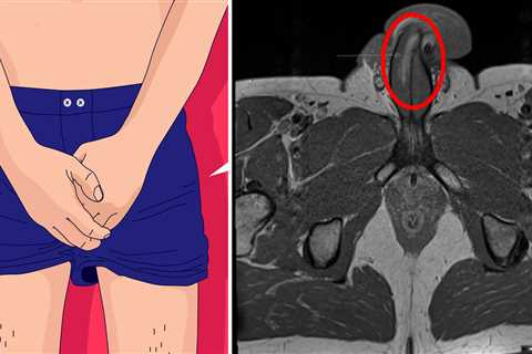 British man breaks penis vertically during sex in first case of its kind