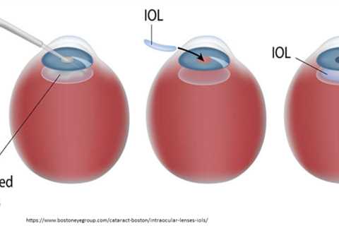 I will soon be able to get bionic eye lenses