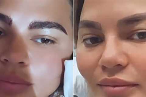 Chrissy Teigen shares the results of "Eyebrow Transplant Surgery"