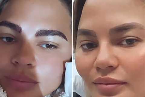 Chrissy Teigen Shares Results of 'Eyebrow Transplant Surgery'