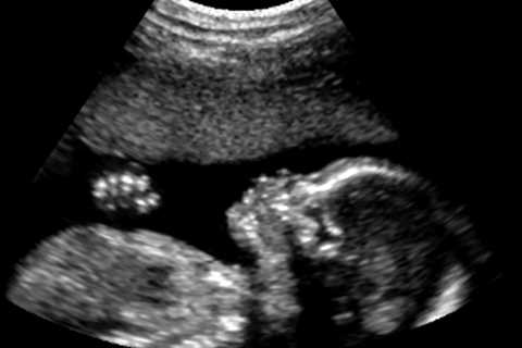 Study: Cash Aid for Poor Mothers Improves Brain Function of Babies