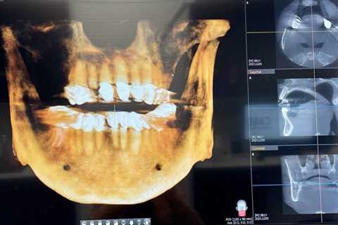 My oral surgery