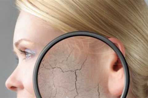 Best Diet For Dry Skinned People