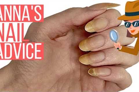 YELLOW NAILS &amp; CRACKED NAIL. ANNA HELP!! [ANNA'S NAIL ADVICE] ?️‍♀️