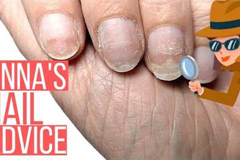 NAILS SEPARATING FROM NAIL BED!! ANNA HELP!!  [ANNA'S NAIL ADVICE]