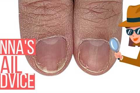 SHOULD I COVER THIS NAIL DAMAGE? [ANNA'S NAIL ADVICE]
