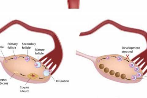 7 Tell Tale signs of PCOS You Should Know About