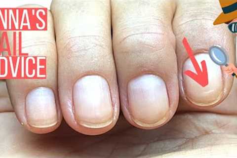 NAIL DAMAGE GROWING OUT! SUCCESS STORY. YAY! ?  [ANNA'S NAIL ADVICE]