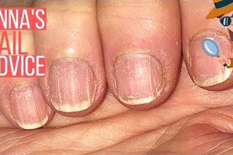 How To Care For Ridgy Nails  [ANNA'S NAIL ADVICE] ?️‍♀️