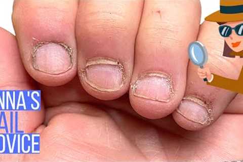 Working Hands, Bitten Nails, Overgrown Skin [Anna's Nail Advice]