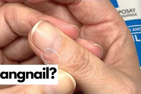 Hangnails. Emergency Fix.