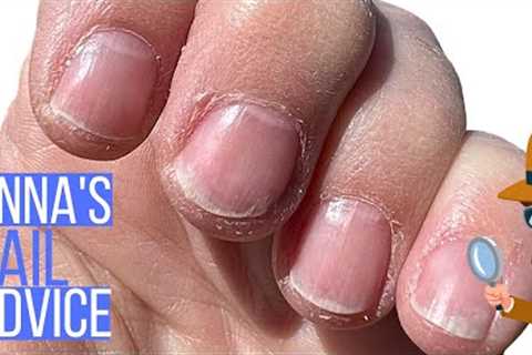 Can You Rebuild Damaged Nails? [Anna's Nail Advice]