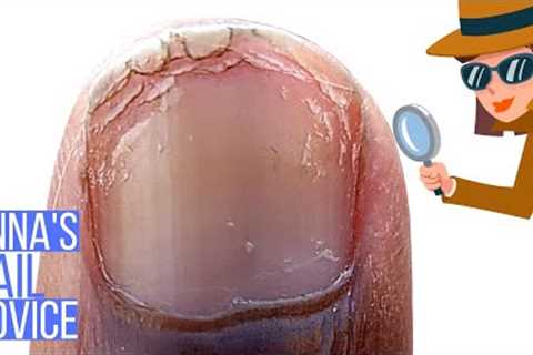 Peeling Nail Problem? 10 Things To Seriously Consider! [Anna's Nail Advice]
