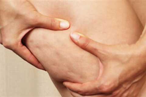 How To Prevent Cellulite Formation