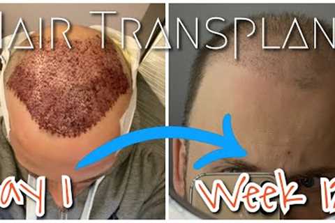 Week 12 Update New Hair Growing, Timelapse, Hair Transplant Turkey 2020
