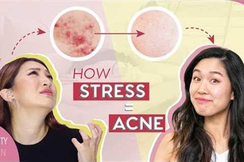 5 Signs + 5 Easy Cures to Prevent ACNE and STRESSED Skin