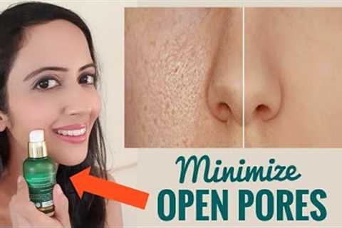 How I am treating my OPEN PORES | Enlarged Pores - Causes &amp; Treatment