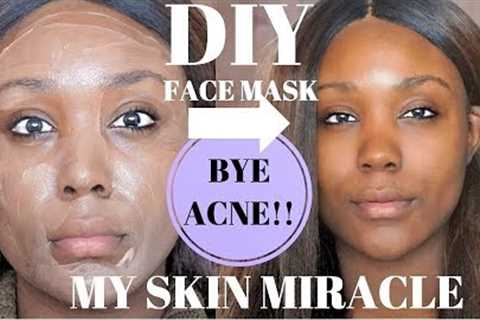 OILY SKIN ACNE CHEAP SKIN CARE ROUTINE!!! REMOVE ACNE/ DARK SPOTS CLEAR SKIN FAST  - Rose Kimberly