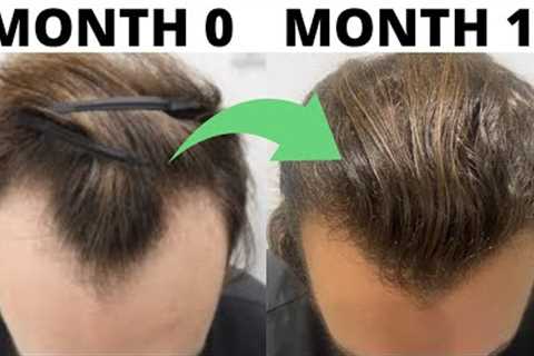 SEVERE Hair Loss To EPIC Hair Growth (Subscriber REVERSES Male Pattern Baldness In 1 Year)