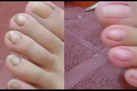 INGROWN REMOVAL PEDICURE CLEANING PAOLA /SATISFYING CLIENT72 @Che che Legario