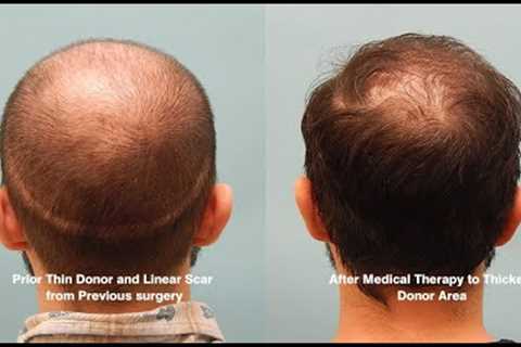 Extracellular Vesicles for Hair Growth - Patient Hair Loss Journey