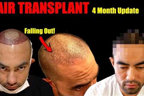 My Hair Transplant Results After 4 Months | Hair Falling Out