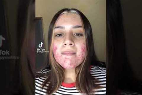 Watch My Acne Go Away❤️ (tiktok) #shorts credit fatyysinfiltro
