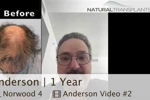 Hair Transplant Procedure Results | Hair Transplantation Before and After | Dr. Rose (Anderson)