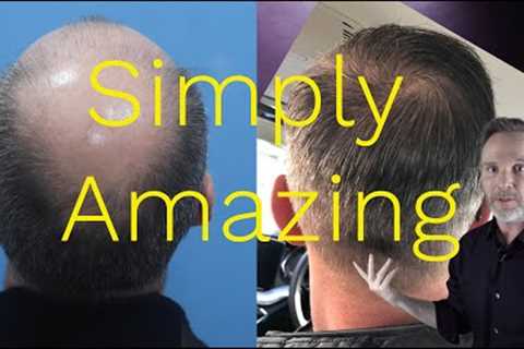 Crown Hair Transplant Results - Eugenix Hair Sciences