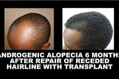 Hair Growth Time-frame After Hair Transplant