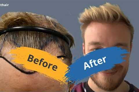 Hair Transplant Before and After - hair transplant time lapse