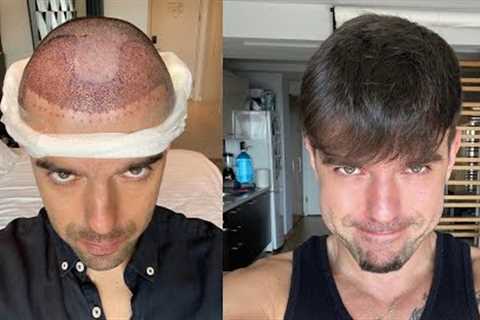 Hair Transplant Results With Pictures | 1 Year Transformation | Alain Bruno