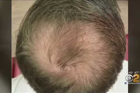 Can PRP Injections Spark Hair Growth?