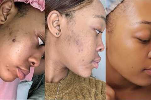 The Skin Care Routine that cleared my acne &amp; hyperpigmentation | OG Parley
