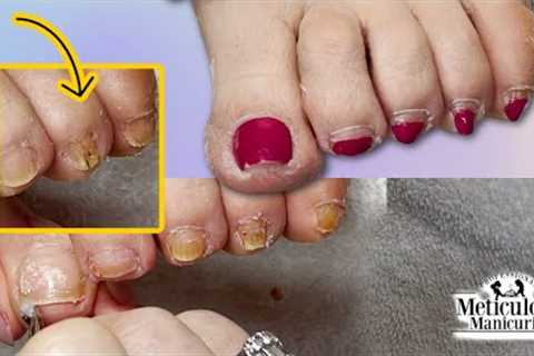 👣What are these Dark Spots on a Big Pinched Toenail?👣