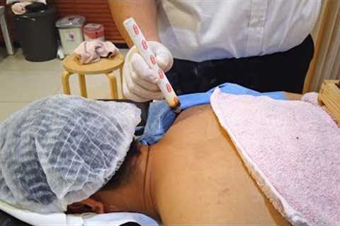 Unreal CHINESE MEDICAL THERAPY That Relieve Back &amp; Shoulder Pains (Moxibustion)