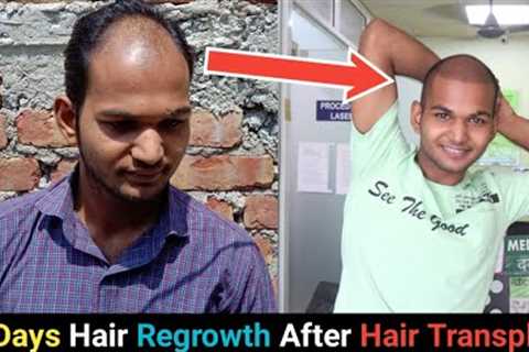 15 Days Hair Regrowth Time Lapse After Hair Transplant In India 2020।