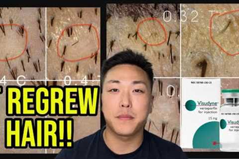 THE BIGGEST BREAKTHROUGH IN HAIR LOSS HISTORY WITH VERTEPORFIN...**UNBELIEVABLE RESULTS**