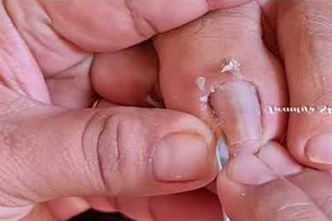 How to remove the cuticle and ingrown properly?|Satisfying pedicure(Part1) | Beauty's Skills