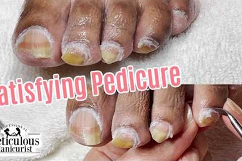 👣Pedicure Tips for Excessive Impacted Cuticle and Yellow Toenails👣
