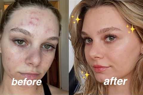 Everyday Natural Makeup Routine with Acne | how i cover my acne
