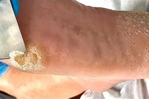 Callus removal from feet&amp;Foot scraping dead skin【Xiao Yan pedicure】#stress 6