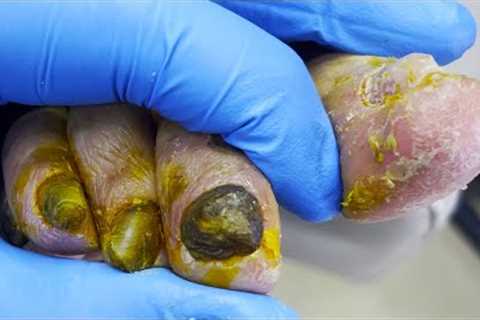 Five nails are all infected, professional manicure, very stress relief