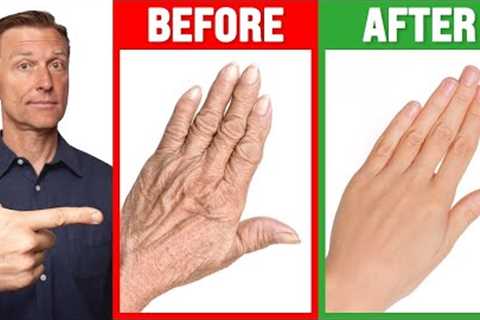 #1 Absolute Best Remedy for Dry and Wrinkled Hands