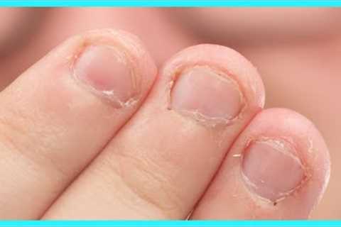 Fix Bitten Nails and Avoid Allergies with My Hack!