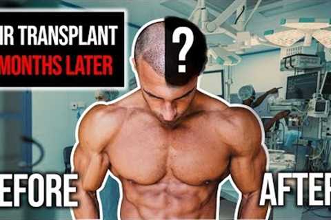 Hair Transplant Results After 6 Months | Before &amp; After