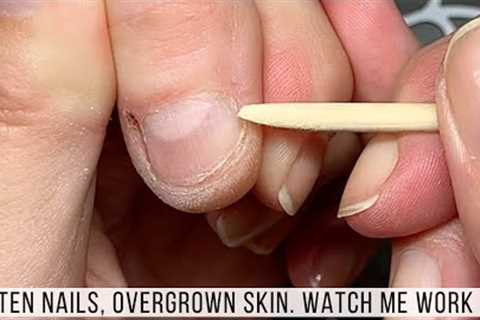 Manicuring Bitten Nails with Overgrown Skin. New Client. | Watch Me Work