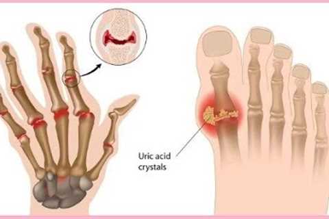 7 Natural Remedies for Arthritis Pain Relief