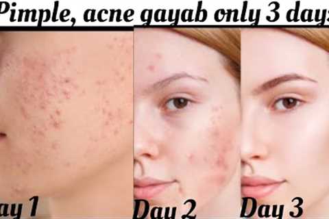 How to remove pimple overnight/3 to 7 days challenge, naturally, acne treatment